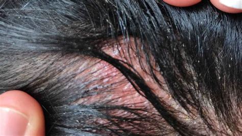 Womans Allergic Reaction To Hair Dye Causes Severe Swelling In Face Head