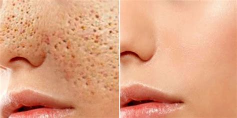 How To Get Rid Of Large Pores By Using This Simple Home Method The