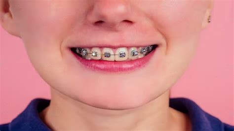 The Best Braces Colors The Comprehensive Guide In 2023