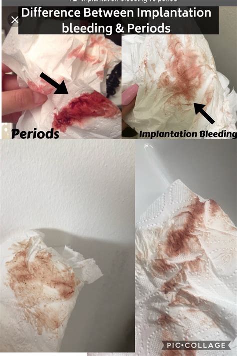 What Does Implantation Bleeding Discharge Look Like