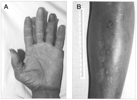 Computed Tomography Angiogram In Diagnosis Of Churg Strauss Vasculitis