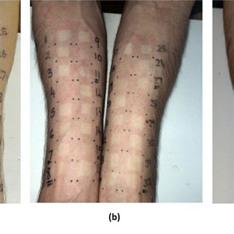 Typical Skin Blanching Responses After Randomized Application Of 00025