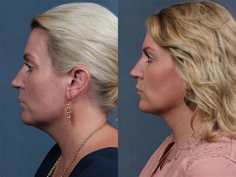 Kybella Before And After Photos Patient 634 Louisville Ky Calospa