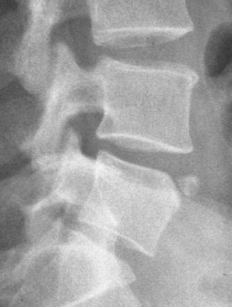 Spinal Fractures Radiology Reference Article Radiopaedia Org