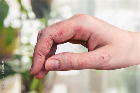 Psoriasis Of The Skin On A Womans Hand Peeling Rashes And Cracks In