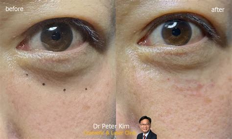 Dark Circle Correction Tear Trough Deformity Dr Peter Kim Cosmetic