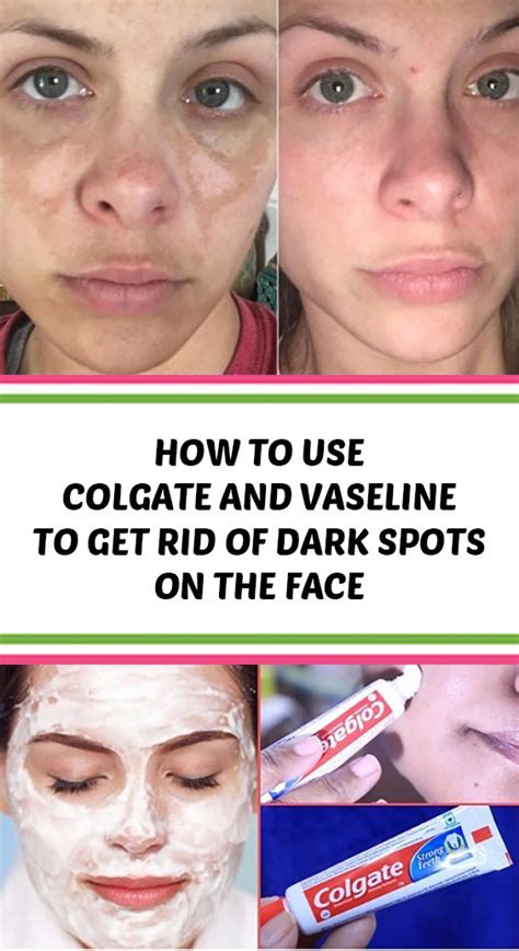 How To Use Colgate And Vaseline To Get Rid Of Dark Spots On The Face