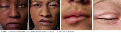 Hives And Angioedema Symptoms And Causes Mayo Clinic