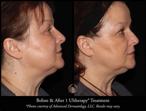 Ultherapy Skin Tightening Procedure Chicago Il Advanced Dermatology