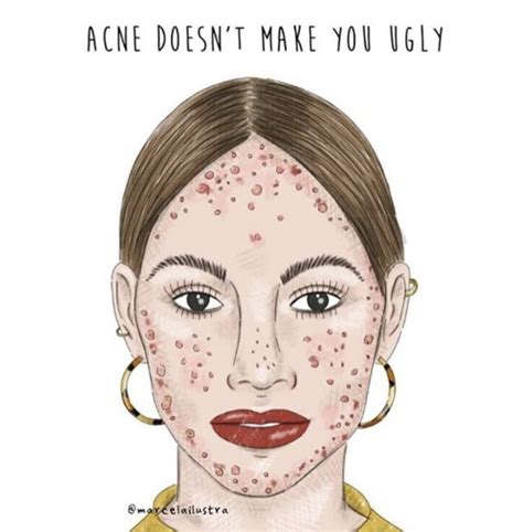 Body Positive Quotes Body Positivity Art Beauty Standards Quotes Girl With Acne Normal