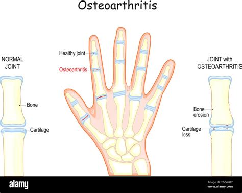 Osteoartritis Huesos De Una Mano Humana Primer Plano Del Cartílago