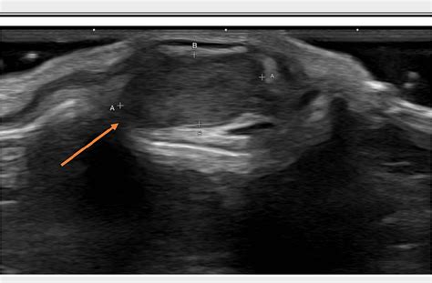 Figure 1 From First Branchial Cleft Cyst Confined To The Pinna