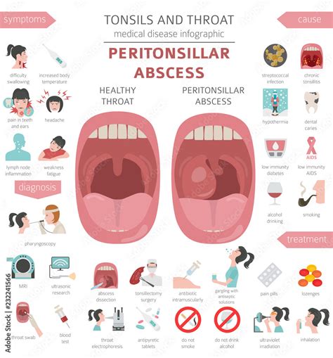 Tonsils And Throat Diseases Peritonsillar Abscess Symptoms Treatment