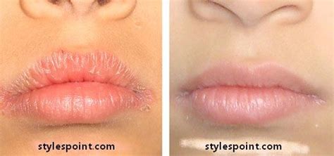 Dry Lips Usually Marked By Cracked Or Painful Lips And May Cause Red