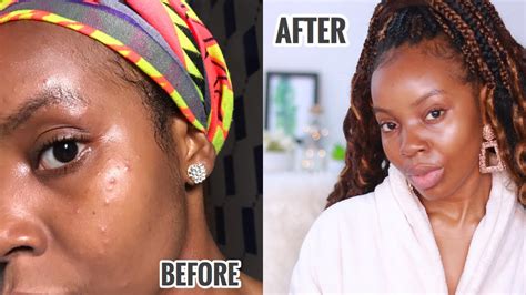 How I Cleared My Skin In A Week My In Depth Skincare Routine My