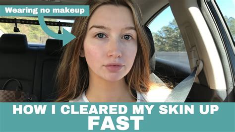 How To Get Clear Skin Fast Tricks To Get Rid Of Acne Youtube