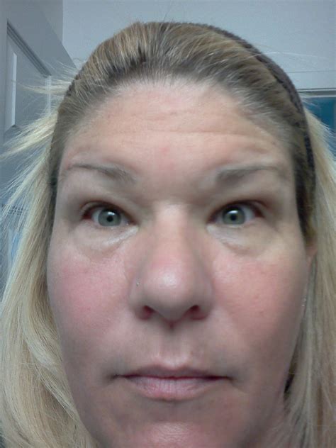 Life With Lupus Swellingedema And Visual Issues