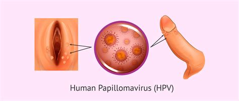 Gyakori kérdések, szakértői válaszok érhetően a HPV-ről | negerove.lt