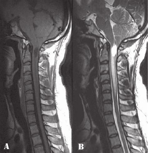 Preoperative Cervical Spine Magnetic Resonance Imaging Mri Sagittal