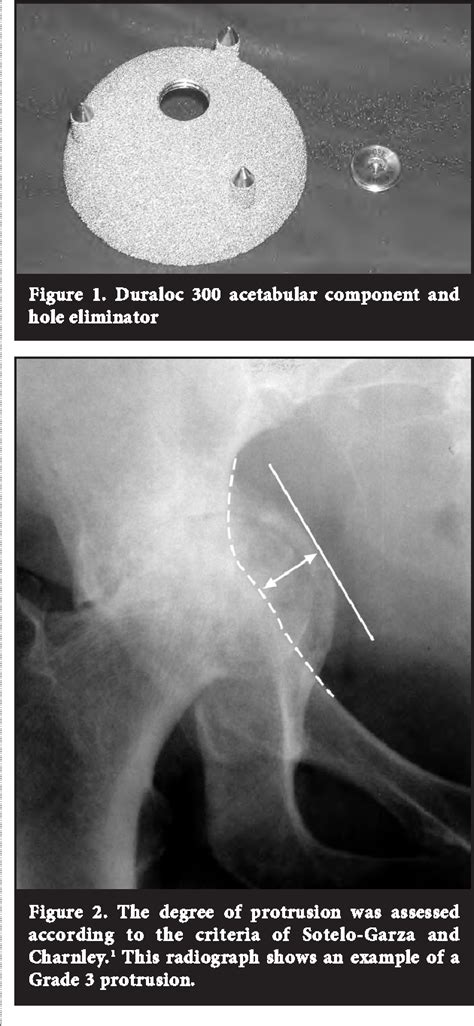 Figure 2 From The Results Of A Cementless Acetabular Component Combined