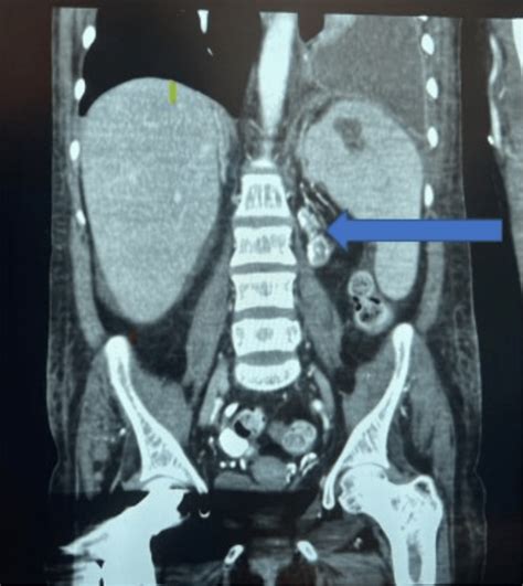 Cureus A Rare Case Of Horseshoe Kidney With Multiple Atrial Myxomas