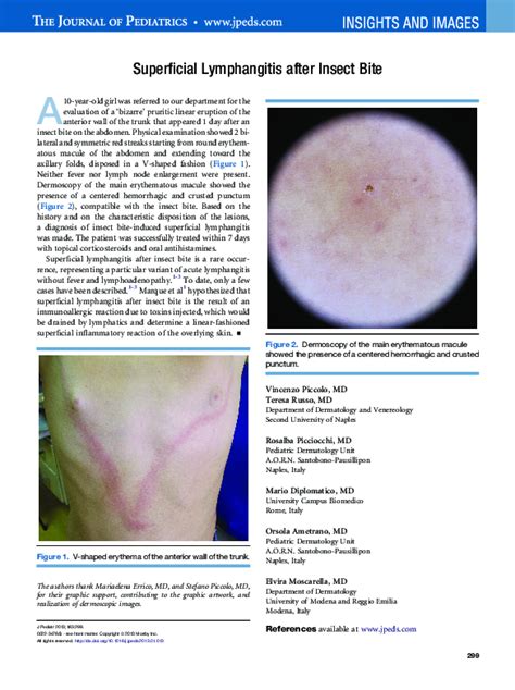 Pdf Superficial Lymphangitis After Insect Bite Vincenzo Piccolo