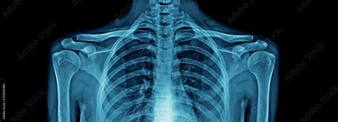 Upper Part Of Human Body X Ray High Quality Chest X Ray And Part Of