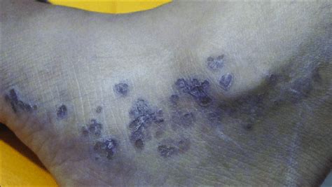 Linear Porokeratosis On The Foot And Ankle Porokeratosis Too Has Been