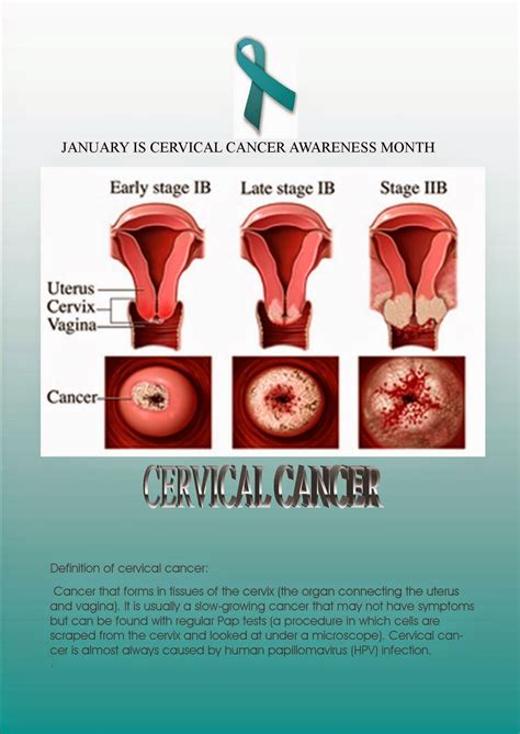Cervical cancer incidence and mortality cervical cancer second most common cancer in malaysia, furthermore, it is the fourth most common cause of death in women in malaysia. my life after cervical cancer: What a Stage B Cervical ...