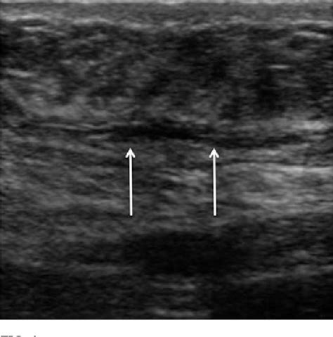 Ultrasound Guided Drainage Of A Seroma Following Tumescent Liposuction