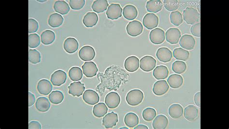 White Blood Cells Crawling Under The Microscope 1000x Magnification