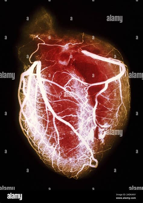 Healthy Heart Coloured Arteriogram X Ray Or Angiogram Showing In