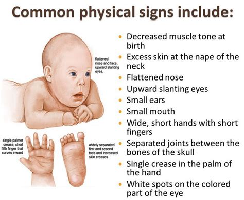 The genetic basis of down syndrome. Down syndrome pictures