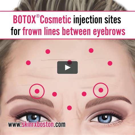 The Beginners Guide To Botox 8 Things To Know Before You Go Artofit