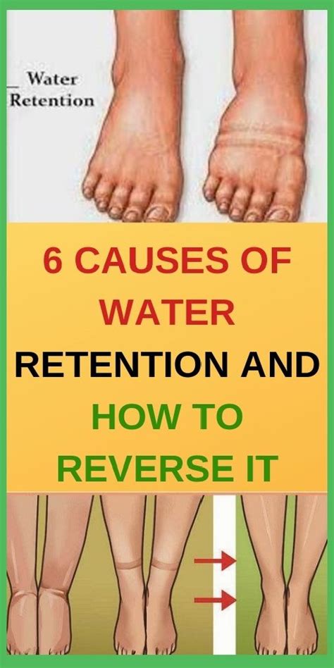 6 Causes Of Water Retention And How To Reverse It Shape Your Body In