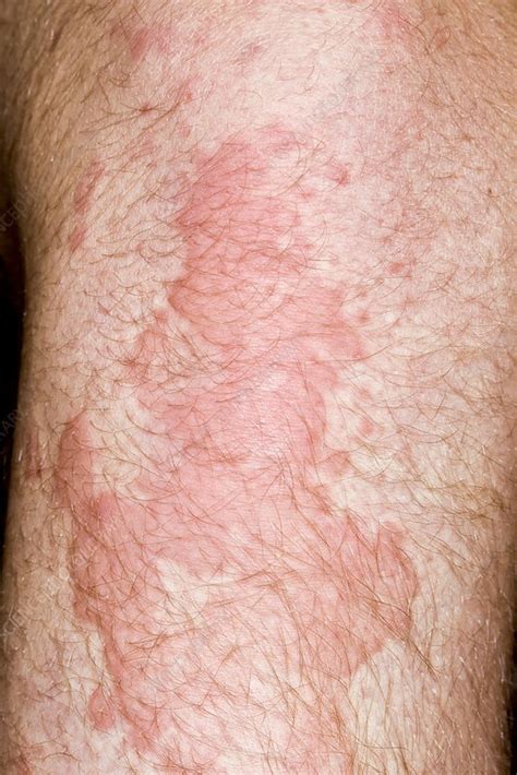 Urticaria Stock Image C0269174 Science Photo Library