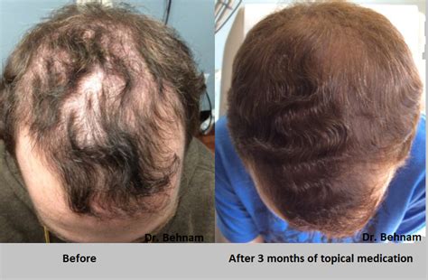 Topical Finasteride For Hair Growth Men And Women Hair Loss