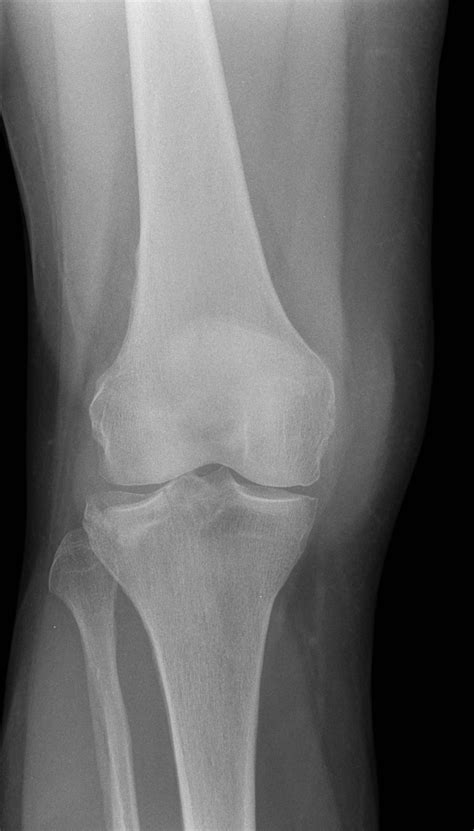 Tibial Fracture X Ray