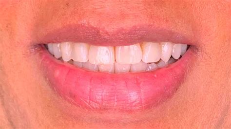 Before And After Photos Invisalign Clear Braces Gallery Odessa Fl