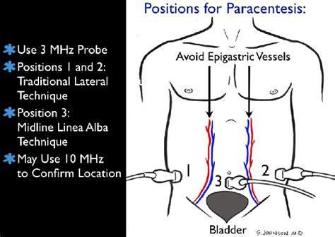 Paracentesis Probe Placement Download Scientific Diagram