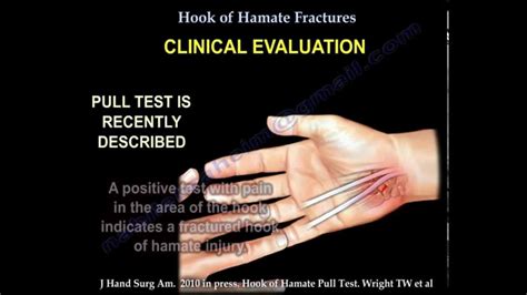 Hook Of Hamate Fracture Everything You Need To Know Dr Nabil