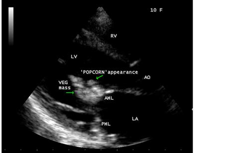 Rheumatic Mitral Valvulitis With A “giant Vegetation”—a Case Report
