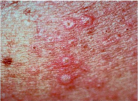 Emerging Systemic Fungal Infections Clinics In Dermatology