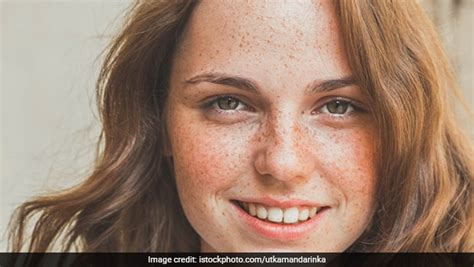 5 Natural Ways To Get Rid Of Freckles On Face Ndtv Food