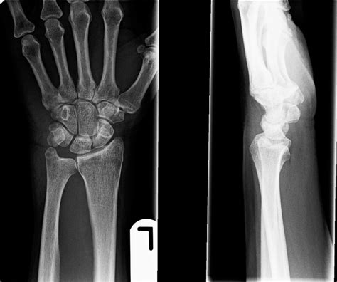 Pisiform Fracture Causes Symptoms And Treatment Health News Website