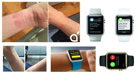 Is Apple Watch Causing Skin Irritation Apple Says It Is Your Fault