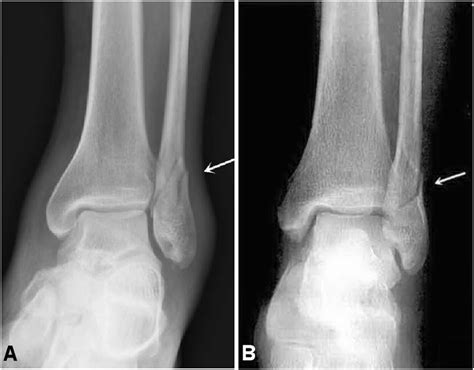 Fibular Fracture Ab Is Shown At The Inferior Tibiofibular Joint