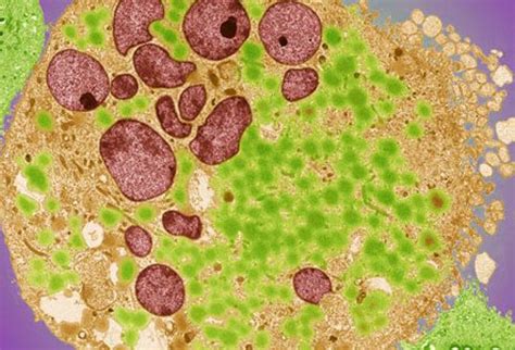 Bladder cancer is characterized by the presence of blood in urine. Bladder Cancer Symptoms, Stages, Treatment