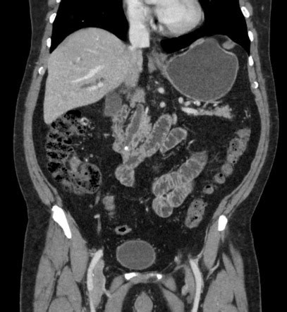 Ampulla Of Vater Stone And Pancreas Divisum Radiology Case Radiopaedia Org