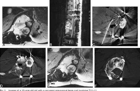 Pdf Treatment Of An Aneurysmal Bone Cyst Of The Spine By Radionuclide